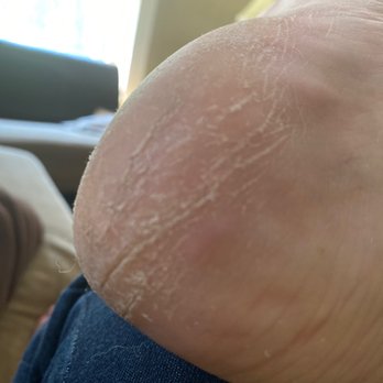 Tip Top Nail Spa - This is a pic , taken less than half an Hour after my $28 pedi!!! - Nail Salons Near Me - Clifton Park, New York