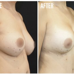 Alexander M Sailon, MD - Breast Augmentation Revision