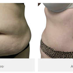 Castellano Cosmetic Surgery Center - Castellano Cosmetic Surgery Center Tummy Tuck Patient