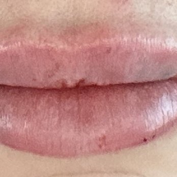 Injection Bar Medspa & Wellness - Immediately after another syringe in my dermatology clinic. This was Juvederm Ultra XC instead. - Medical Spas Near Me - Richmond, Texas Injection Bar Medspa & Wellness - Immediately after another syringe in my dermatology clinic. This was Juvederm Ultra XC instead. - Medical Spas Near Me - Richmond, Texas