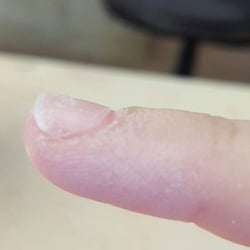 Angels Nails - The damage done by one of the nail techs at Angel's Nails. Refused to remove tip, kept filing at my natural nail. Very painful.