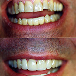 Eldersburg Family Dental - Before and after dental makeover