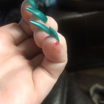 Fancy Nails II - Blister on left hand after it popped - Nail Salons Near Me - Fishers, Indiana