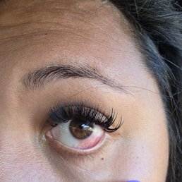 A picture of my right eye irritated and red.