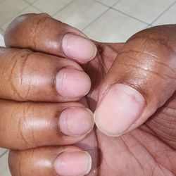 After removal of my birthday nails viewing over-filing  damage