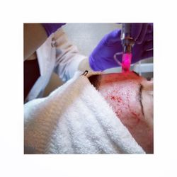 Javan Anti-Aging & Wellness Institue - PRP Facials! Also known as blood facials. Best way to boost collagen, get rid of acne scars, and treat pigmentation!