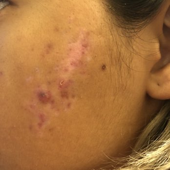 The Moroccan Spa - This is a week later and I'm loving the results!!! - Skin Care Near Me - Lomita, California The Moroccan Spa - This is a week later and I'm loving the results!!! - Skin Care Near Me - Lomita, California