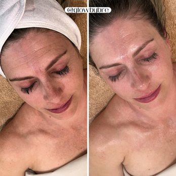Glow By Bre - Before and after magic from the custom glow treatment - Skin Care Near Me - Ventura, California Glow By Bre - Before and after magic from the custom glow treatment - Skin Care Near Me - Ventura, California