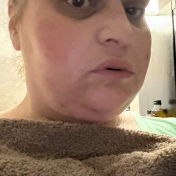 Bionic Smile - Day I had surgery - Cosmetic Dentists Near Me - Las Vegas, Nevada