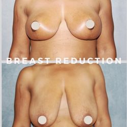 David Godat, MD - Breast Reduction Before & After