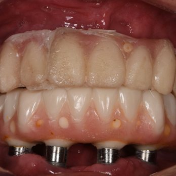 D Andrew Lewis, DDS, FAGD - Dr. Lewis did this. He is completely incompetent. - General Dentistry Near Me - Seattle, Washington D Andrew Lewis, DDS, FAGD - Dr. Lewis did this. He is completely incompetent. - General Dentistry Near Me - Seattle, Washington