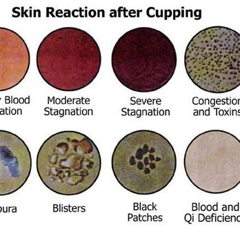 Magic TCM - Cupping Print Analysis - Acupuncture Near Me - San Antonio, Texas Magic TCM - Cupping Print Analysis - Acupuncture Near Me - San Antonio, Texas