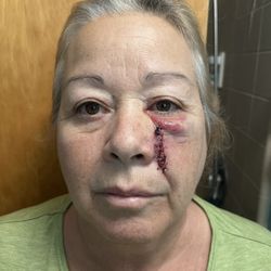 Contour Dermatology & Cosmetic Surgery Center - Day after surgery.