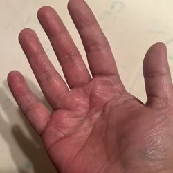 McDonald's - This is a pic of my hand burned and swollen because of the coffee burn. I put burn cream on it but didn't help much.