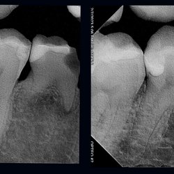 New Smile Dental - Patient with a broken infected tooth extracted and replaced with an implant on the same appointment.