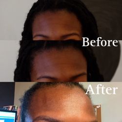 Bellevue Laser and Cosmetic Center - Before and after botox