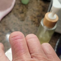 Sprouts Farmers Market - Hand injury.