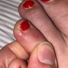 Villa Nail and Spa - Updated picture itchy and clearly healing from something - Nail Salons Near Me - Lancaster, Ohio