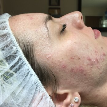 Tucson Acne Clinic - BEFORE - Skin Care Near Me - Tucson, Arizona Tucson Acne Clinic - BEFORE - Skin Care Near Me - Tucson, Arizona