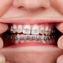 Top Smile Orthodontics - SUNNYVALE - Teen braces.