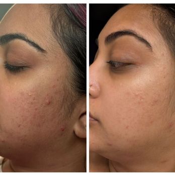 Skin Alchemy Collective - Before vs a week after - Medical Spas Near Me - Wilton Manors, Florida Skin Alchemy Collective - Before vs a week after - Medical Spas Near Me - Wilton Manors, Florida
