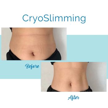 Inspired Beauty Med Spa - Cryoslimming
Get that summer ready body only at Inspired Beauty Med Spa - Medical Spas Near Me - Manlius, New York Inspired Beauty Med Spa - Cryoslimming
Get that summer ready body only at Inspired Beauty Med Spa - Medical Spas Near Me - Manlius, New York