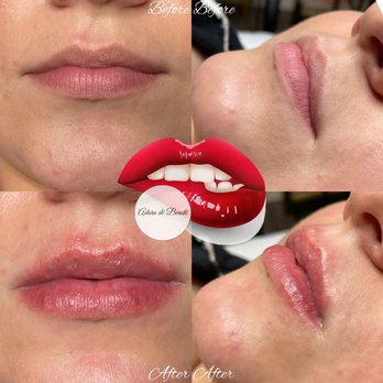 Adara De Beauté - NON INVASIVE LIP FILLER (NO NEEDLES) - Nail Salons Near Me - Milwaukee, Wisconsin Adara De Beauté - NON INVASIVE LIP FILLER (NO NEEDLES) - Nail Salons Near Me - Milwaukee, Wisconsin