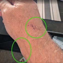 Andrew Bronstein, MD - It's obvious to anyone paying attention that the wrist is bruised, scraped, and the swelling on the lower wrist. Xray tech wasn't attentive