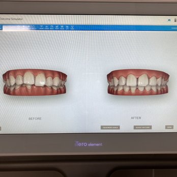 Union Dental Center - Come in for your FREE smile evaluation! We can digitally simulate your PERFECT SMILE in SECONDS on our top-of-the-line ortho scanner! - General Dentistry Near Me - Los Angeles, California Union Dental Center - Come in for your FREE smile evaluation! We can digitally simulate your PERFECT SMILE in SECONDS on our top-of-the-line ortho scanner! - General Dentistry Near Me - Los Angeles, California