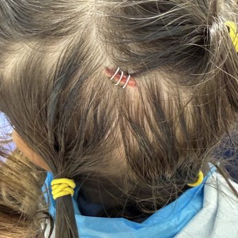 Instant Pediatric Urgent Care - Neat staple procedure to close a head wound laceration. Cleaned her wound well and made sure her head was thoroughly numb. - Pediatricians Near Me - Plano, Texas Instant Pediatric Urgent Care - Neat staple procedure to close a head wound laceration. Cleaned her wound well and made sure her head was thoroughly numb. - Pediatricians Near Me - Plano, Texas