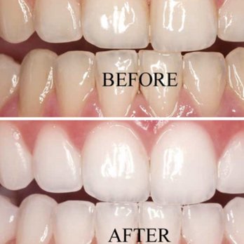 Zen Lashess - Teeth whitening - Eyelash Service Near Me - Los Angeles, California Zen Lashess - Teeth whitening - Eyelash Service Near Me - Los Angeles, California