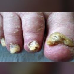 SF Fungal Nail Treatment Clinic