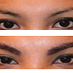 Elite Hair Institute - Female Patient after 3 month of treatment
