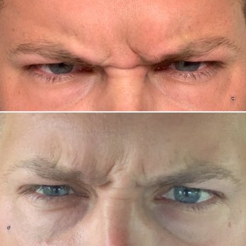 Ideal Image Tampa - Laser Hair Removal Near Me - Tampa, Florida Ideal Image Tampa - Laser Hair Removal Near Me - Tampa, Florida