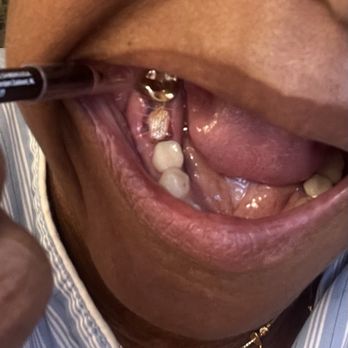 Carmen Ramos, DMD - Hour post surgery. Day One - Periodontists Near Me - Manhattan Beach, California Carmen Ramos, DMD - Hour post surgery. Day One - Periodontists Near Me - Manhattan Beach, California