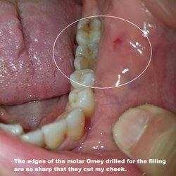 Luke A Omey, DDS - This shows the slice in my cheek from the sharp edges of the molar Omey drilled on.