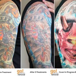 Removery Tattoo Removal & Fading