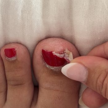 Lavender Nails & Spa - Before pedicure - broken toe nail - Nail Salons Near Me - Roseville, California Lavender Nails & Spa - Before pedicure - broken toe nail - Nail Salons Near Me - Roseville, California