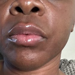 First time day 1 Lip filler, one full syringe