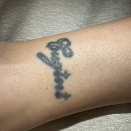 Tattoo that was burned Tattoo that was burned
