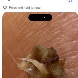 Epiphany Dermatology - Definitely not a keratin plug.