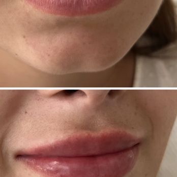 Eden Medspa - Russian Lips 1mL - Medical Spas Near Me - Solon, Ohio
