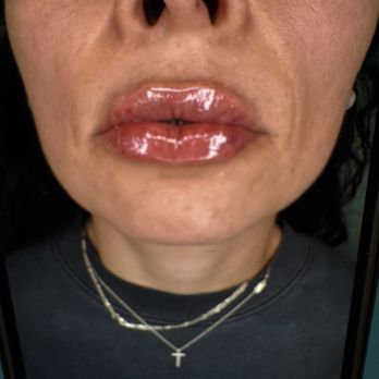 Sol And Skin - Juicy lips! Minimal swelling - Medical Spas Near Me - San Diego, California Sol And Skin - Juicy lips! Minimal swelling - Medical Spas Near Me - San Diego, California