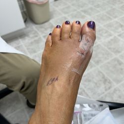 Atlantic Foot Specialists - Two days after surgery