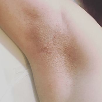 Bellingham Wax Studio - Underarm before and after - Waxing Near Me - Bellingham, Washington