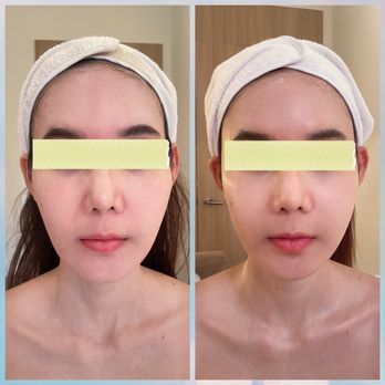 Genesys Laser Clinic - I'm thrilled with my result! I'm so proud of it. Thanks Aileen! - Laser Hair Removal Near Me - New York, New York Genesys Laser Clinic - I'm thrilled with my result! I'm so proud of it. Thanks Aileen! - Laser Hair Removal Near Me - New York, New York