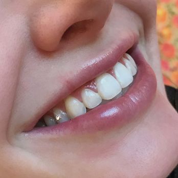 Sudden Gleam - Swarovski Crystal Tooth Gem - Teeth Whitening Near Me - Gilbert, Arizona Sudden Gleam - Swarovski Crystal Tooth Gem - Teeth Whitening Near Me - Gilbert, Arizona