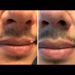Lasting Lines - Before & after skin tag removal on lip