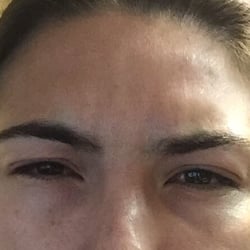 Frown lines being treated using Botox. Great results!