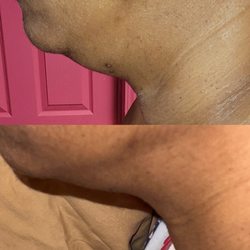 Lyv Natural Beauty - Radio frequency on chin and neck